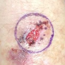 arm Carcinoma before