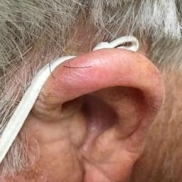 ear Carcinoma after