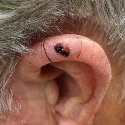 ear Carcinoma before