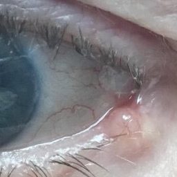 eye Carcinoma before