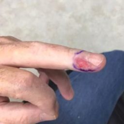 finger Carcinoma before