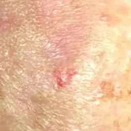 forehead Carcinoma after